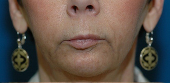 Lip lift + Chin implant + ArteFill
