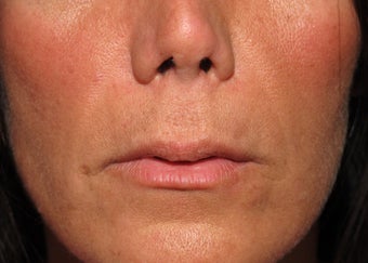 Lip lift - permanent lip enhancement