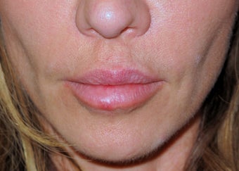 lip lift