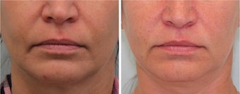 Bullhorn Lip Lift