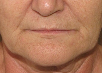 Lip lift