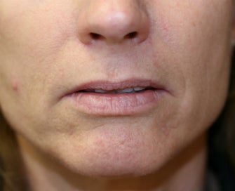 Lip lift