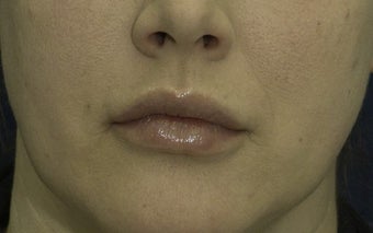 Lip Lift