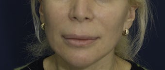 Lip Lift