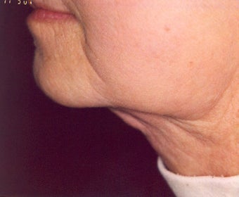Lipodissolve and CoolSculpting