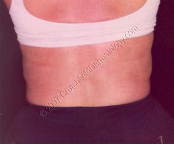 LipoDissolve injections to back fat