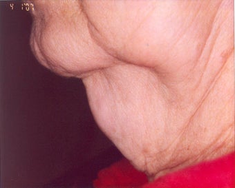 Lipodissolve and CoolSculpting