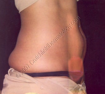LipoDissolve injections to belly fat & love handles