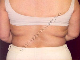 LipoDissolve injections to back fat