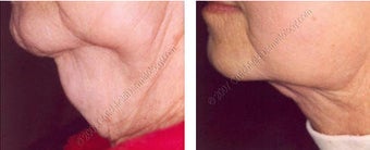 Lipodissolve before and after on chin
