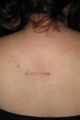 Back lipoma removal