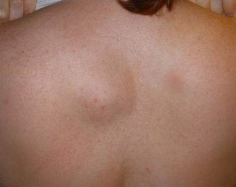Back lipoma removal