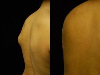 Lipoma Removal with Smartlipo Triplex