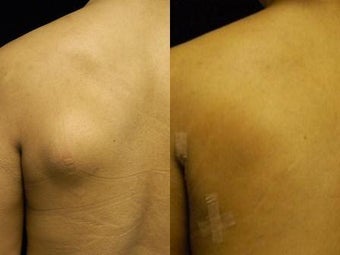 Lipoma Removal with Smartlipo Triplex