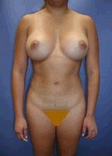 Liposculpture, Liposuction and Breast Augmentation