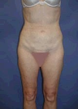 Liposculpture, Liposuction Surgery