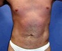 Liposculpture, Liposuction for men