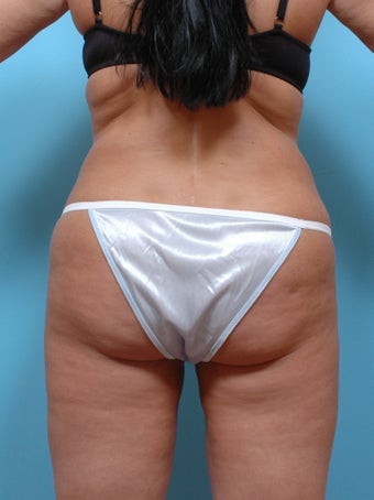 Liposuction