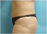 true tumescent lipo