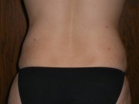 Liposuction