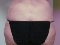 Liposuction