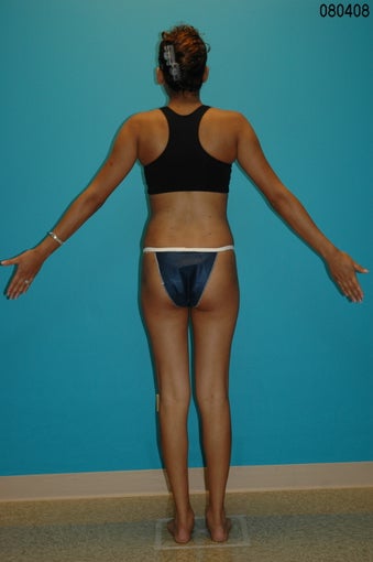 Liposculpture of Hips