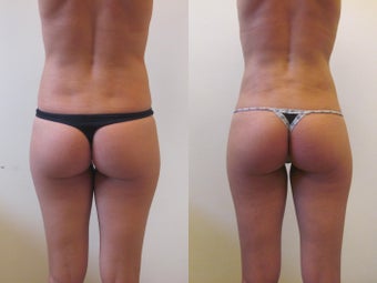 Liposculpture