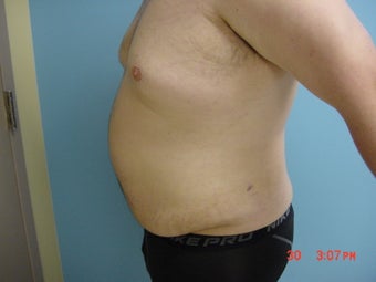 liposuction