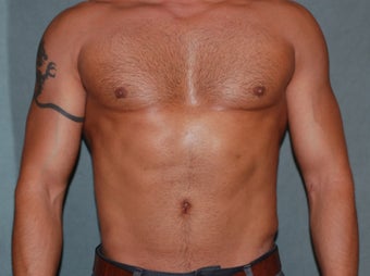 Liposculpting of the abdomen