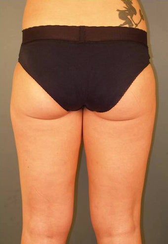 Tumescent Liposuction Under Local Anesthesia.