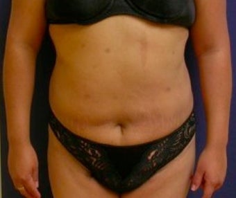 Liposculpture for stomach