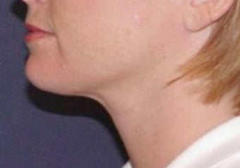 Neck lipo