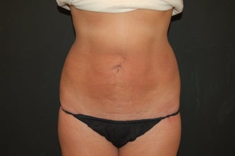 true tumescent liposuction 