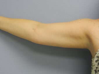 Before Laser Lipo / Arms