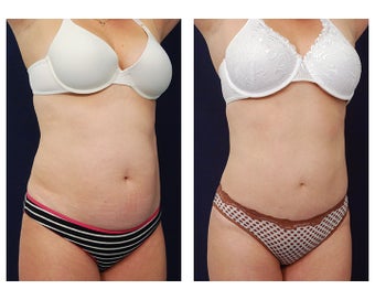 Liposuction