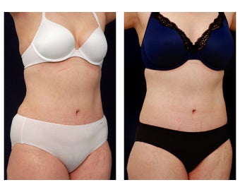 Liposuction
