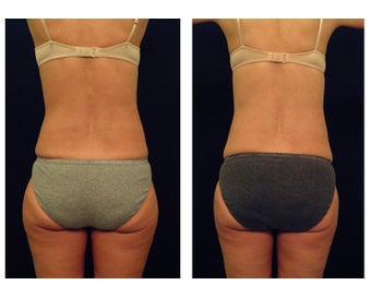 Liposuction