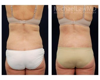 Liposuction