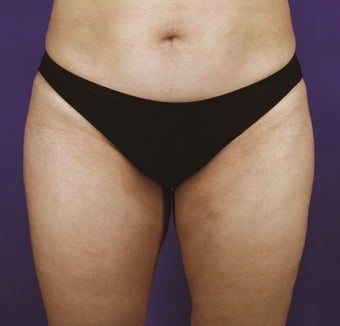 Liposuction of Abdomen, Inner Thighs and Outer Thighs
