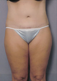 Tummy Tuck
