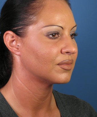 Liposuction