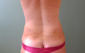 SMART Liposuction of Love Handles