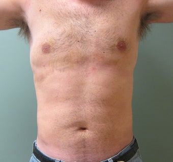 Liposuction of Abdomen, Love handles, Flanks, Chest
