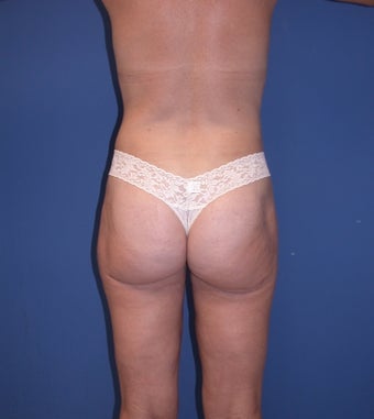 Before & After Liposculpture of the buttocks, thighs & hips
