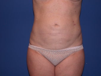Abdominal Liposculpture