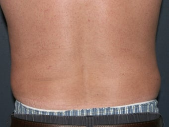 Body Liposculture