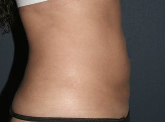Liposculpture
