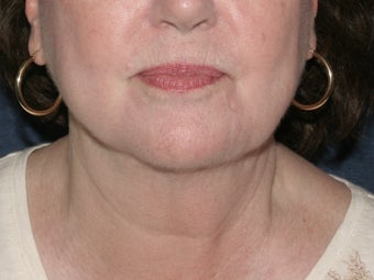 Liposculpture
