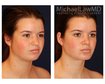 Chin Liposuction