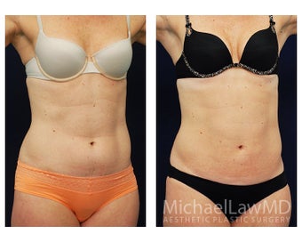 Liposuction